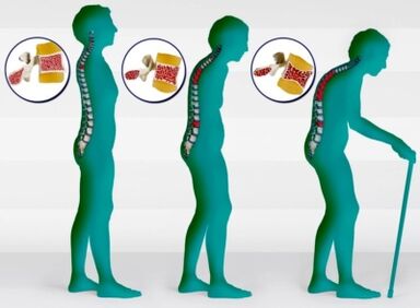 ოსტეოპოროზი